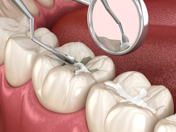 Root Canal Tooth Cracked procedure parramatta
