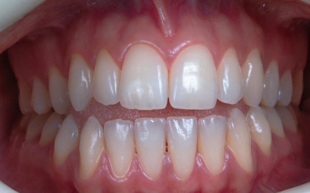 How to Handle a Toothache: Fast Relief & Emergency Signs