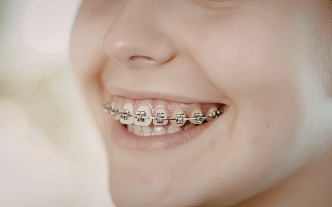 Ceramic Braces vs Metal Braces