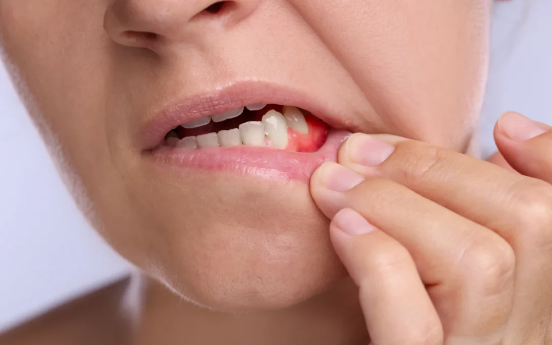 Signs of Tooth Abscess