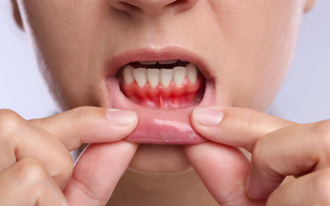 Reverse Receding Gums at Home