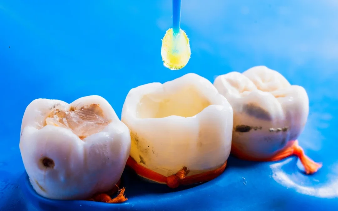 Porcelain Filling vs Composite Filling