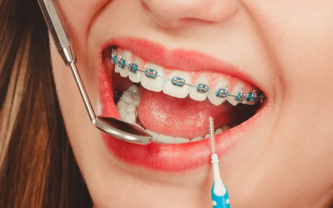 how long does it take to put braces on