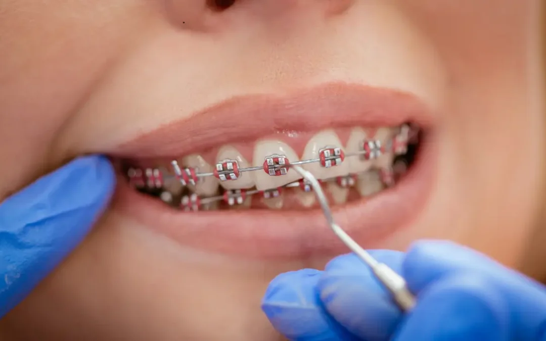 Braces Success Rate
