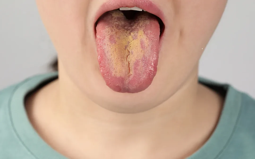 oral thrush