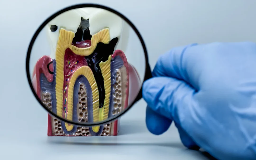 root canal infection