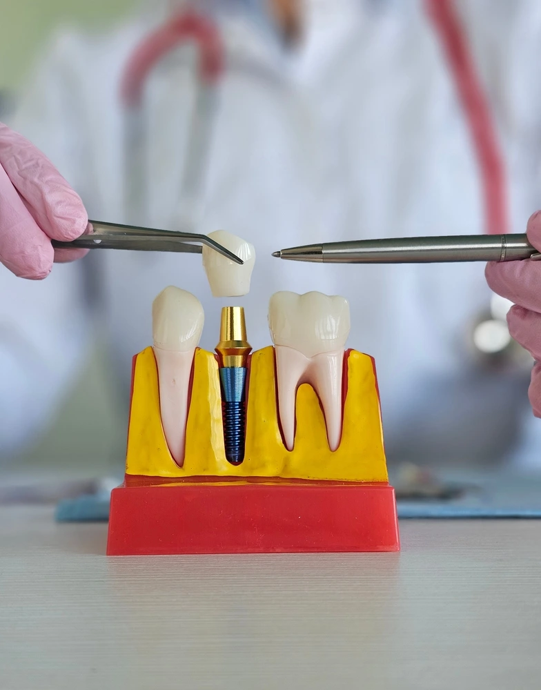 Close-up of a dental implant model with a crown attached by tweezers at Parramatta Green Dental.