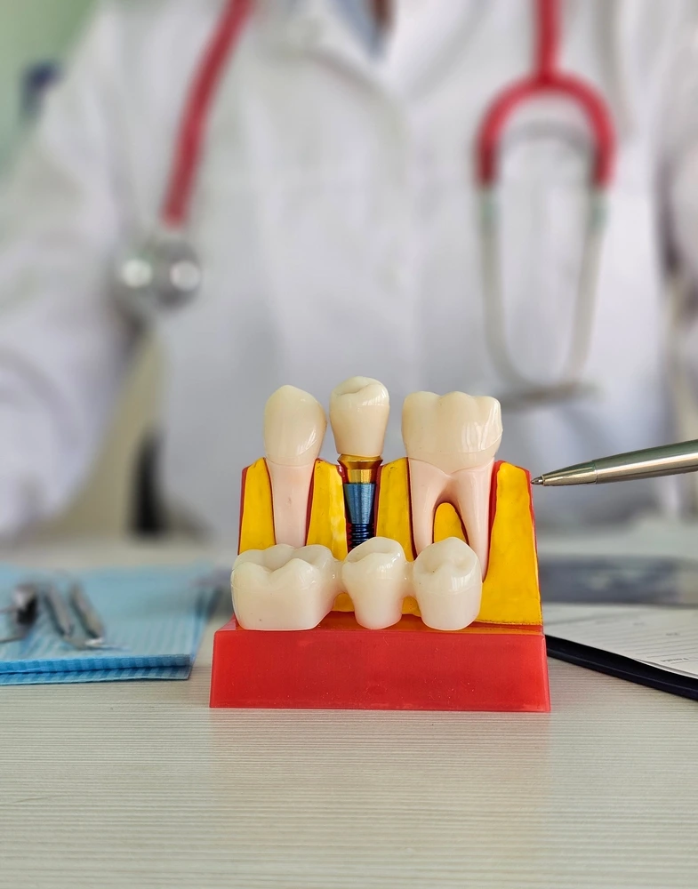 Dental implant model showing crown and root structure on display during a consultation at Parramatta Green Dental.